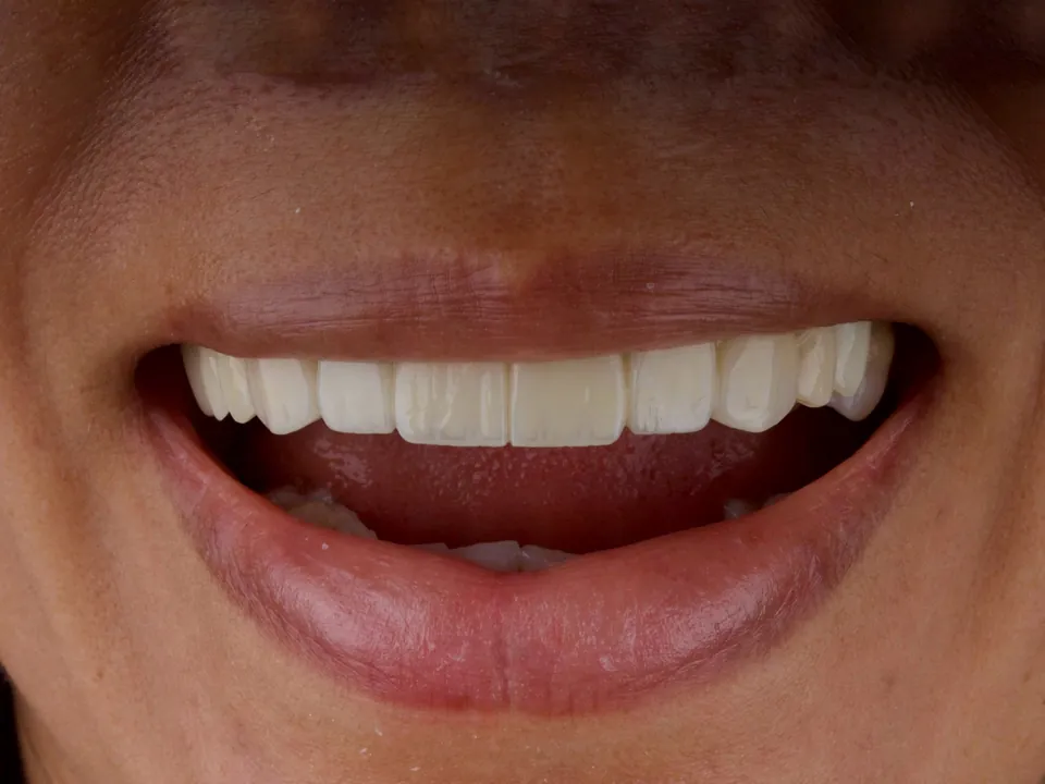 A soft, natural smile result with subtle translucency