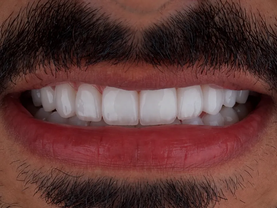 A bright, modern smile result with defined proportions