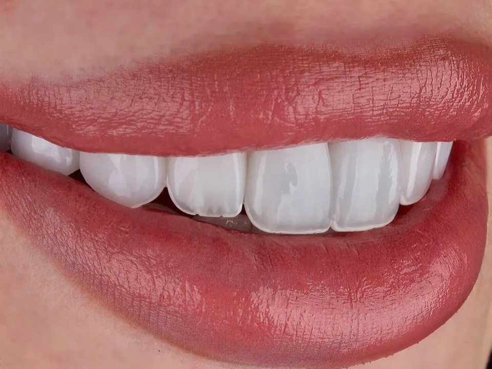 Smile result, case 04