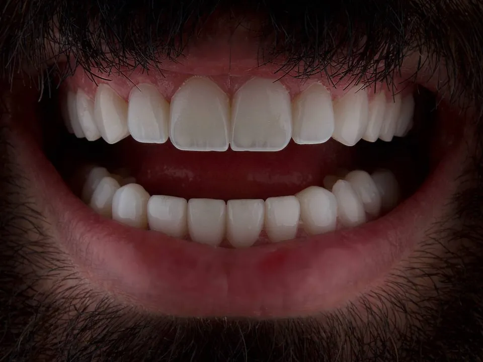 Smile result, case 05