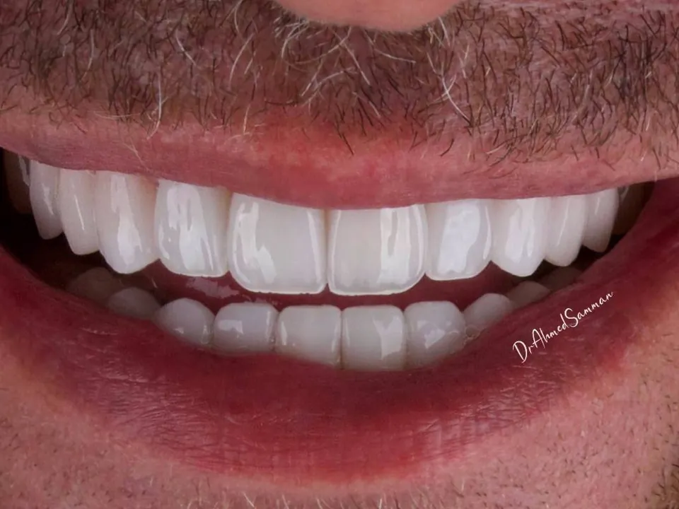 Smile result, case 06