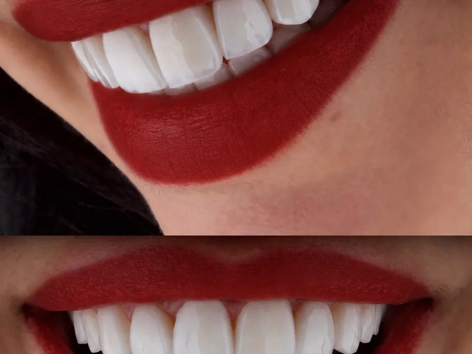 Smile result, case 08