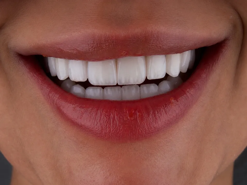 Smile result, case 09