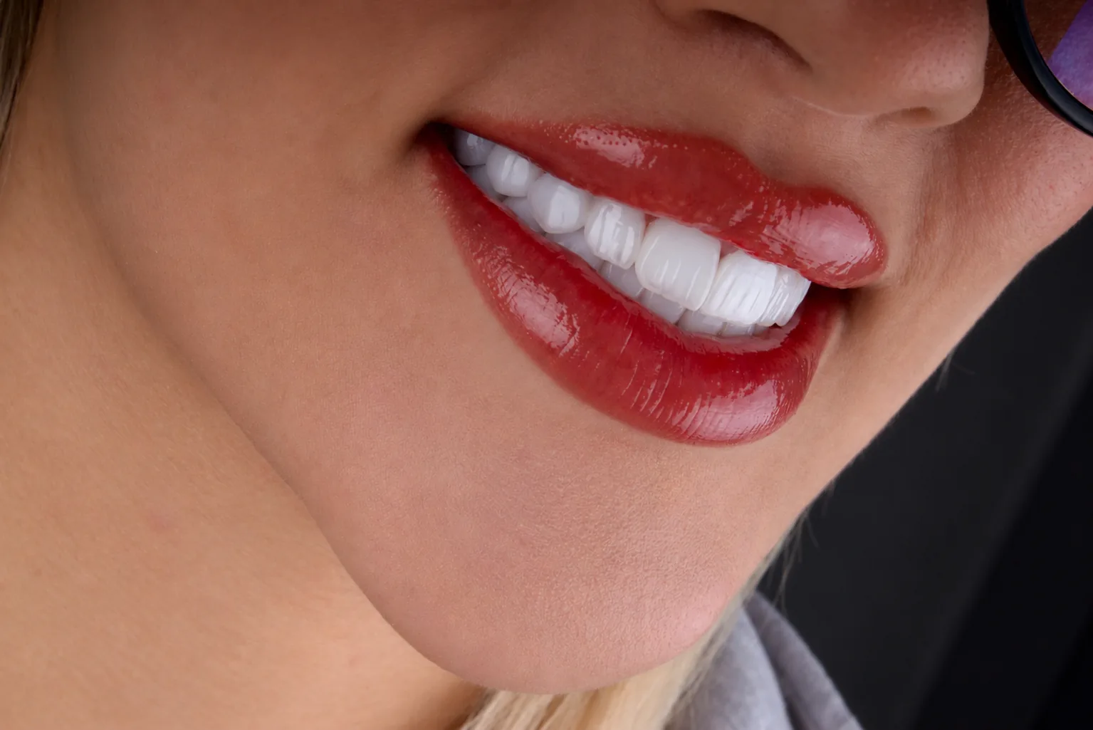 A glossy, natural smile result in profile