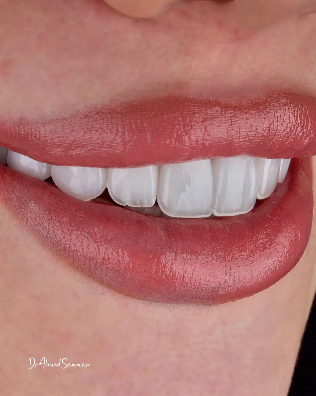 Natural porcelain veneers framed by the lips, showing individual tooth texture